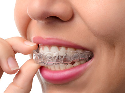 The image shows a person with a clear retainer in their mouth, examining it closely.