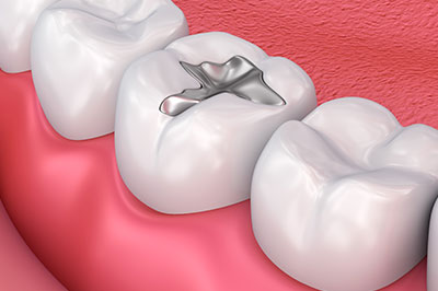 The image shows a close-up of a dental implant integrated into a tooth, set against the backdrop of a human mouth with visible teeth and gums.