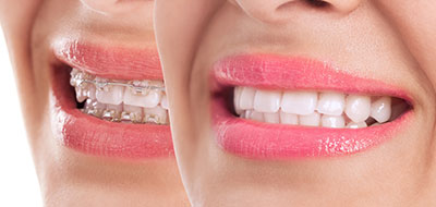 A split-screen image of a smiling woman with pink lipstick, showcasing her teeth and lips.