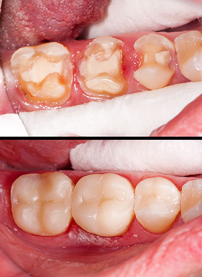 The image shows a close-up of a person s mouth with teeth that appear to be in poor condition, with one side showing an extreme case of tooth decay and damage, while the other side appears to have undergone dental treatment.