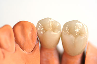 An image of a pair of dentures with artificial teeth and gums, placed side by side on a white background.