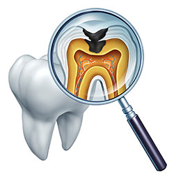 The image shows a magnified view of a tooth with a cavity, viewed through a magnifying glass, and an X-ray showing the internal structure of the tooth with a focus on the affected area.