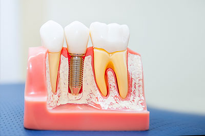 An image of a dental model with multiple teeth showing signs of decay and damage, displaying the process of tooth restoration using a clear plastic mold.