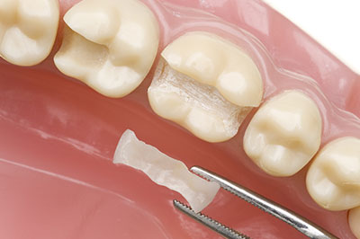 The image shows a close-up of a dental implant being inserted into a tooth socket, with dental tools visible and a partial tooth structure in place.