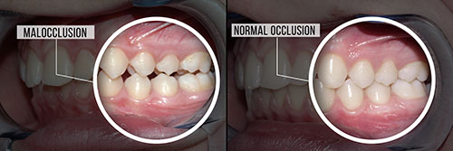 The image is a medical photograph showing two views of a person s mouth with teeth, one with normal occlusion and the other with malocclusion.