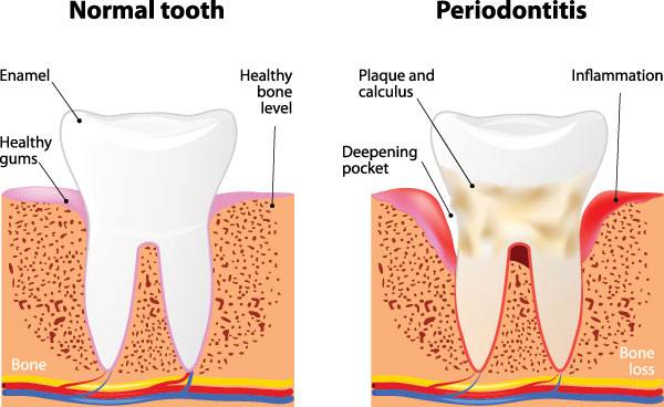 The image is a scientific diagram illustrating the progression of gum disease from normal to periodontitis, highlighting changes in bone and inflammation levels.