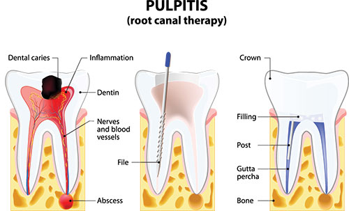 The image is a medical illustration depicting a root canal therapy process, showing the dental pulp area and various steps involved in performing a root canal.