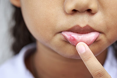 A young child with a visible skin condition, holding their finger to their lips while looking directly at the camera.