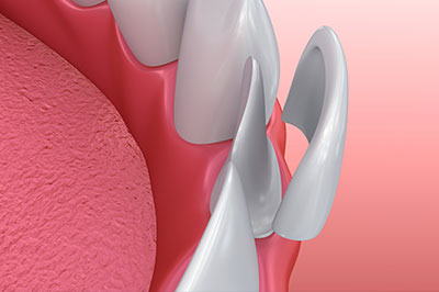 The image shows a close-up view of a dental implant with screws, set against the background of a human mouth, which includes teeth and gums.