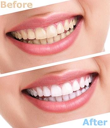 The image shows a side-by-side comparison of a person s teeth before and after dental treatment, with the after picture showing a bright smile.