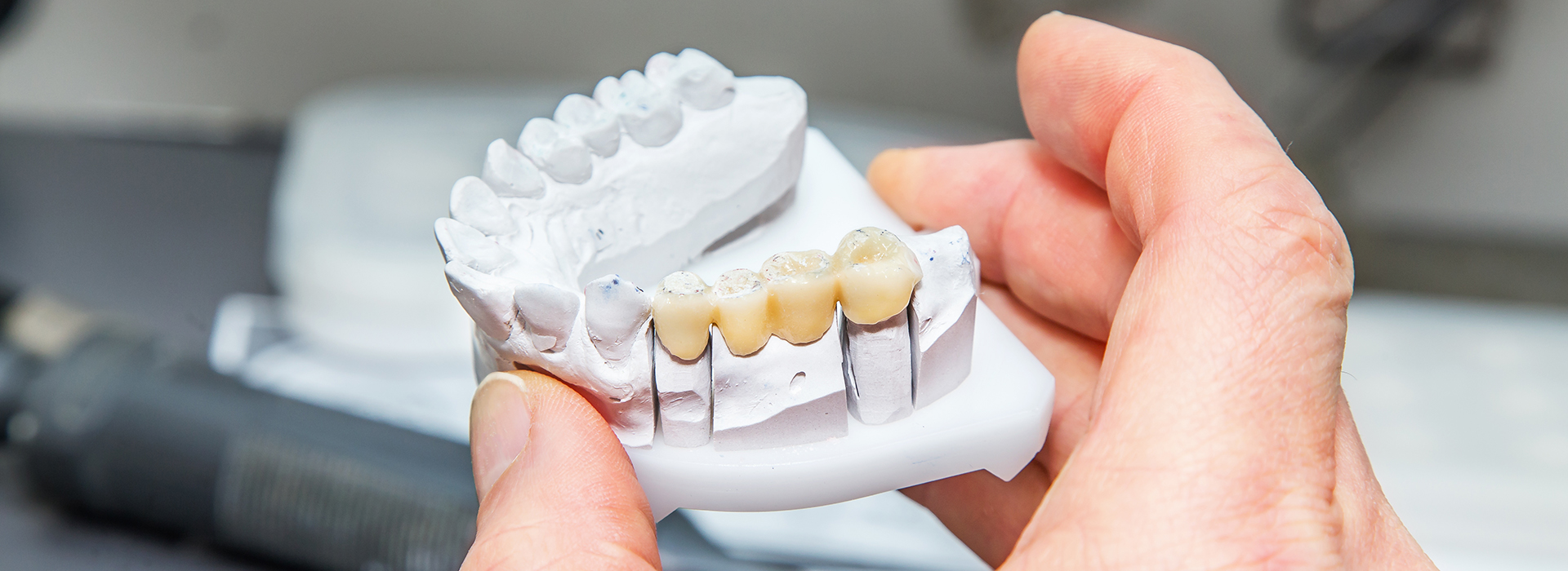 The image shows a person s hand holding a dental model with multiple teeth, possibly for educational or dental planning purposes.