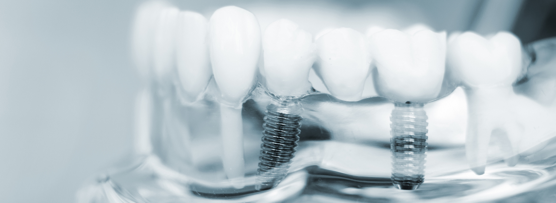 An image of a transparent dental model with multiple teeth, set against a white background.