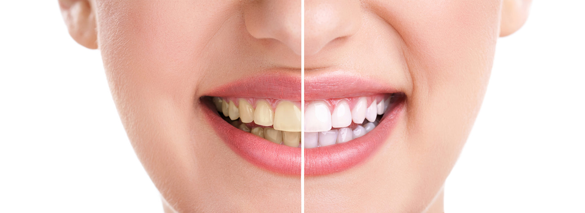 The image is a split-screen comparison of a person s face before and after cosmetic treatment, likely highlighting the results of teeth whitening.