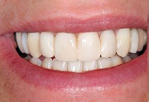 The image shows a close-up of a person s teeth, with the individual smiling and revealing a bright white smile.