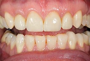An image of a person s mouth with yellowed teeth and gums, showcasing a dental condition or the need for dental care.