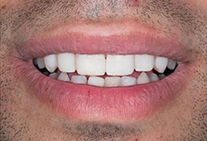 The image shows a close-up of a person s smiling face, with the focus on their teeth and lips.