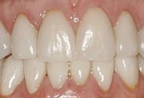 The image shows a close-up of a person s teeth with a focus on the front teeth, which appear to be in need of dental care due to discoloration and possibly decay.