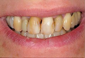 The image shows a person s smile with visible teeth stains, likely intended for dental care or cosmetic purposes.