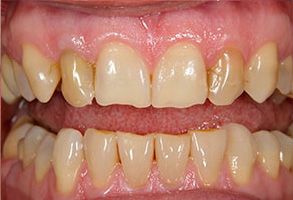 The image shows a close-up of a person s teeth with a focus on the upper front teeth, highlighting their yellowish discoloration and the presence of dental work.