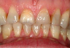 The image shows a close-up of a person s mouth with teeth that appear to be in poor condition, possibly due to decay or gum disease.