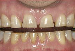 The image shows a close-up view of a person s teeth with visible staining, particularly on the front teeth, which are discolored and appear to be in need of dental care.